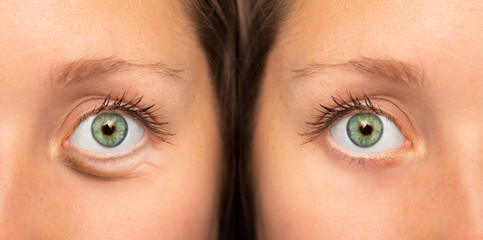 Girl eyes before and after botox injection to remove eye bags
