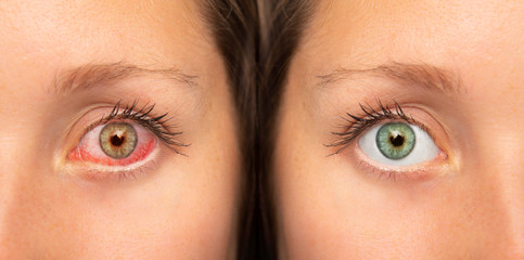 Human red eye before and after eyedrop treatment