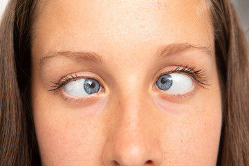 Woman eyes suffering from strabismus