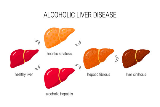 Alcoholic liver disease vector concept