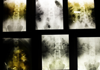 Medical radiographs hip