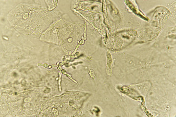 Pseudohyphae and budding yeast cells in patient urine 

