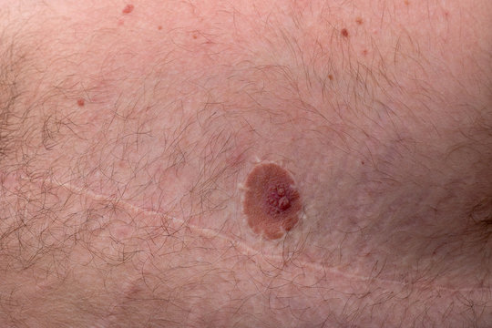 Mastektomie bei einem Mann 