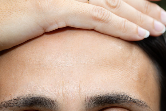 Hand on forehead indicating beginning of female pattern baldness