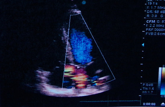 Color image of the ultrasound examination result. Made in an Ultrasound Machine. Human heart. Inter auricular communication (CIA)