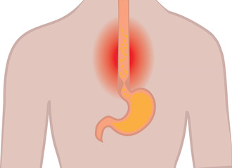 Gastroesophageal reflux desease. Heartburn  Gerd stomach  in a human body vector illustration