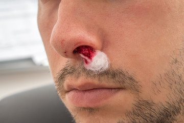 Man with bleeding nose has bloody cotton wool in nostril.