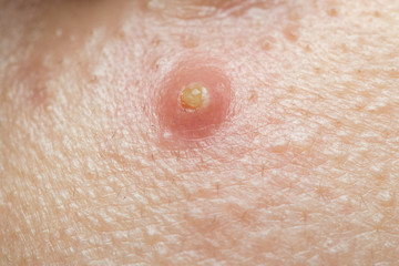 Close Up acne on the skin.