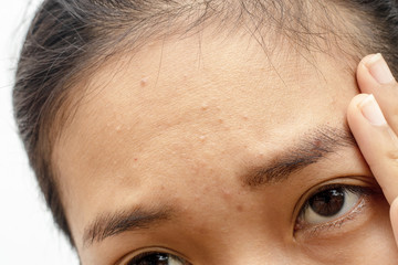 Forehead that is wrinkled and acne of woman.