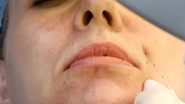 Injectional cosmetology. Young woman gets beauty procedure on face. Beautician in gloves holding syringe with cannula needle.4k