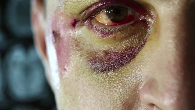 Trauma of face, hematoma of left eye, man with injury of face looks at the camera in medical center, roentgenogram of head at background. It is not a make-up, real trauma after falling off a bicycle