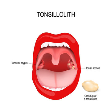 Tonsilloliths and halitosis. Human mouth. close-up of the tonsil stones.