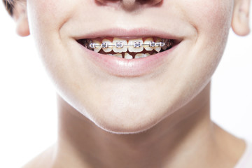 close-up of mouth with dental corrector or braces