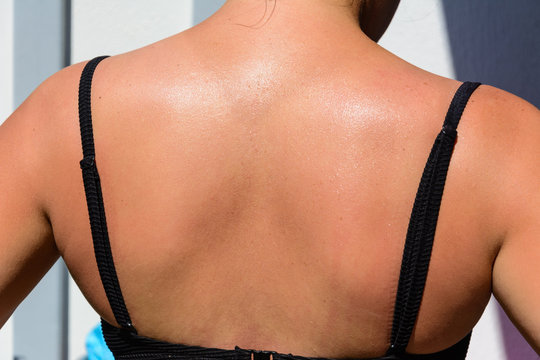 the naked back of the girl with traces of tan primary. red sunburn marks