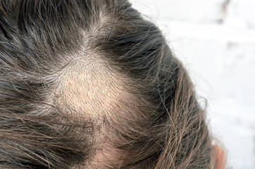 Mycosis of the scalp. Mycosis, stripping on my head. Lishay girl 9 years. Third week of treatment....