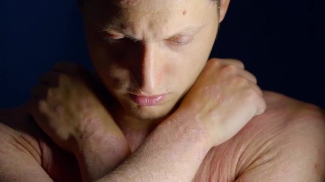 Portrait of a naked male model with crossed arms on his chest, hiding bad dry skin.