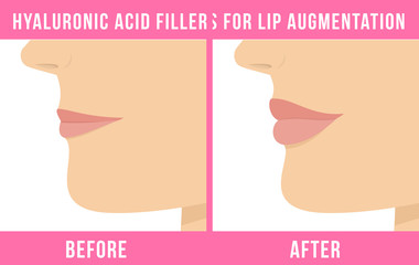 Obraz premium Woman makes procedure of beauty injection for lip augmentation. Lips before and after hyaluronic acid lip filler injection. Vector