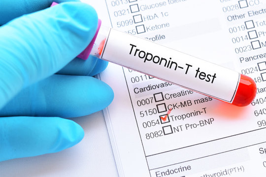 Blood sample tube for Troponin-T test, diagnosis for acute myocardial  infarction (AMI) Photos | Adobe Stock