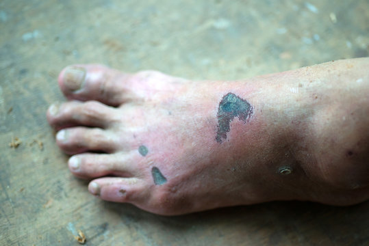 Inflammation swelling at the feet of people.