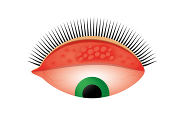 Trachoma vector illustration. Follicles on the upper eyelid