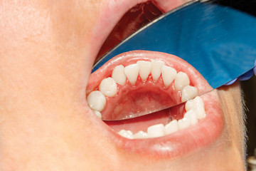 close-up of human mouth teeth after professional whitening in the dental office. The concept of a healthy smile