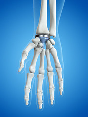 3d rendered medically accurate illustration of a wrist replacement