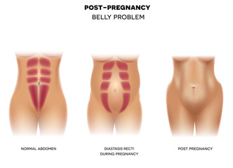 Female body before pregnancy with normal muscles, Diastasis recti during pregnancy and body postpartum colorful illustration on a white background
