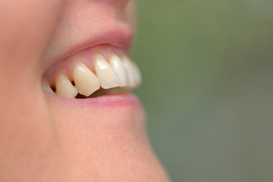 Woman teeth parodontose