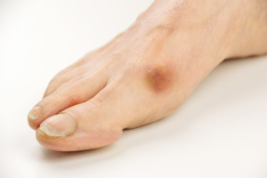 Foot with a bunion