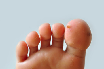 Wart verruca on feet dermatology  - obrazy, fototapety, plakaty