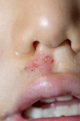 Fototapeta premium Wound on the child's face