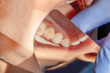 Treatment of caries of a human tooth close-up. The concept of dental restoration of the tooth with composite material.