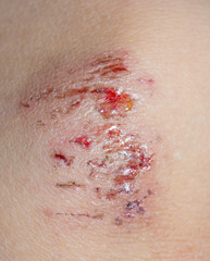 Fototapeta premium Wound on the skin of a macro