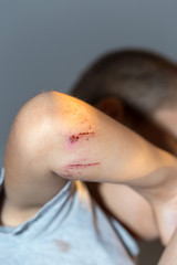 Fototapeta premium The wound on the child's arm