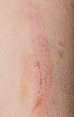 Fototapeta premium Wound on the skin of a macro