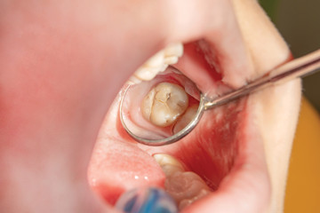 Treatment of caries of a human tooth close-up. The concept of dental restoration of the tooth with composite material.