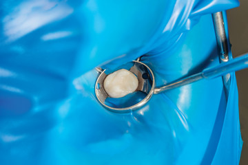 Treatment of caries of a human tooth close-up. The concept of dental restoration of the tooth with...