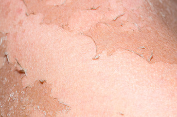 Fototapeta premium burned skin macro