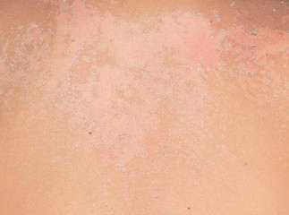 burned skin macro