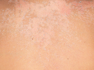 burned skin macro