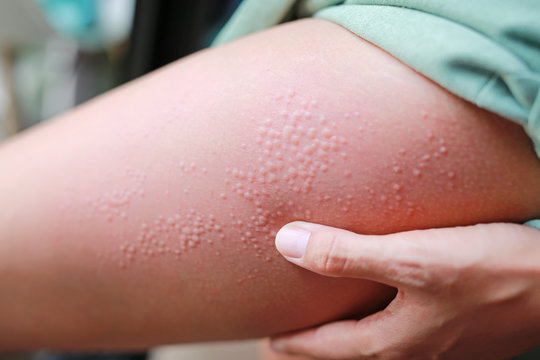 Close-up Allergic Rash Dermatitis Eczema On Woman Leg.