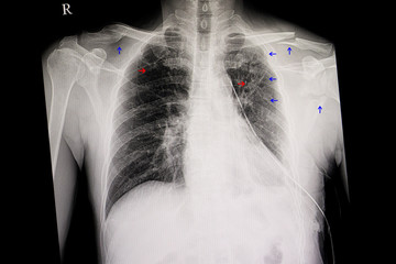 Chest film with multiple fracture