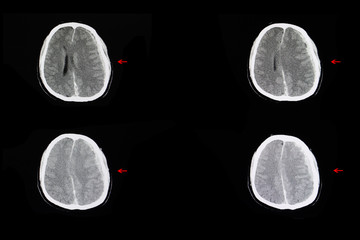 intracranial hemorrhage and brain edema