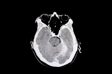 intracerebral hemorrhage