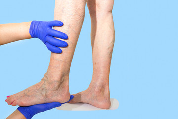 Lower limb vascular examination because suspect of venous insufficiency. The female legs on blue...