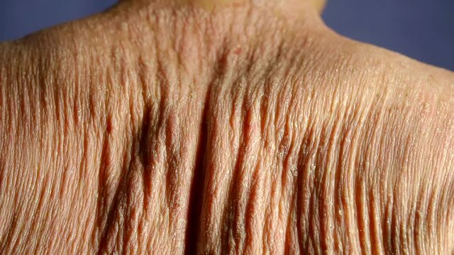 male back with dry, itchy, scaly skin, man is diseased by psoriasis, moving shoulders