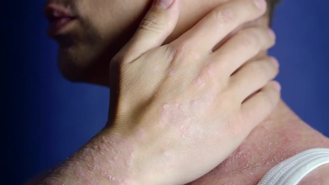 male patient is scratching his psoriasis patches on a skin of neck, standing alone
