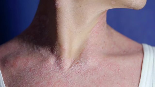 sick man with psoriasis is scratching his dry itchy skin on neck, close-up view