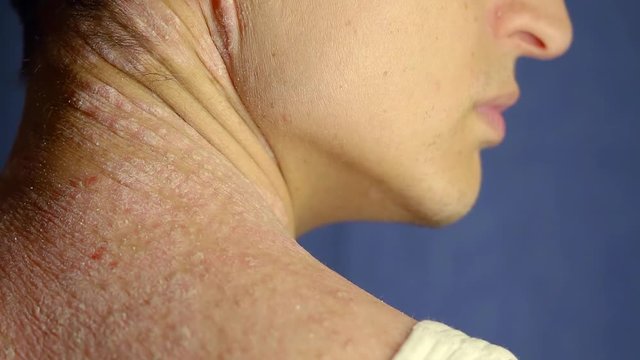 young man with psoriasis is touching his dry, itchy, and scaly skin on neck and back