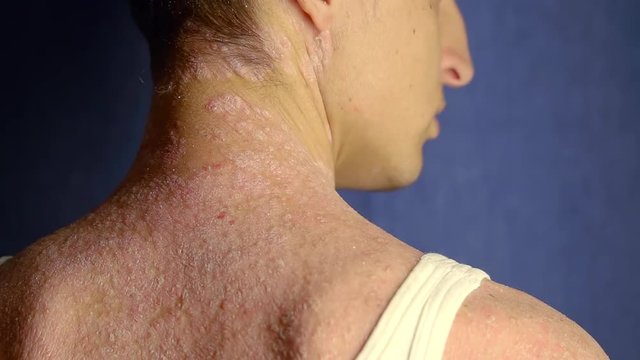dry and scaly skin on a back of male patient, he is standing in clinic on an appointment